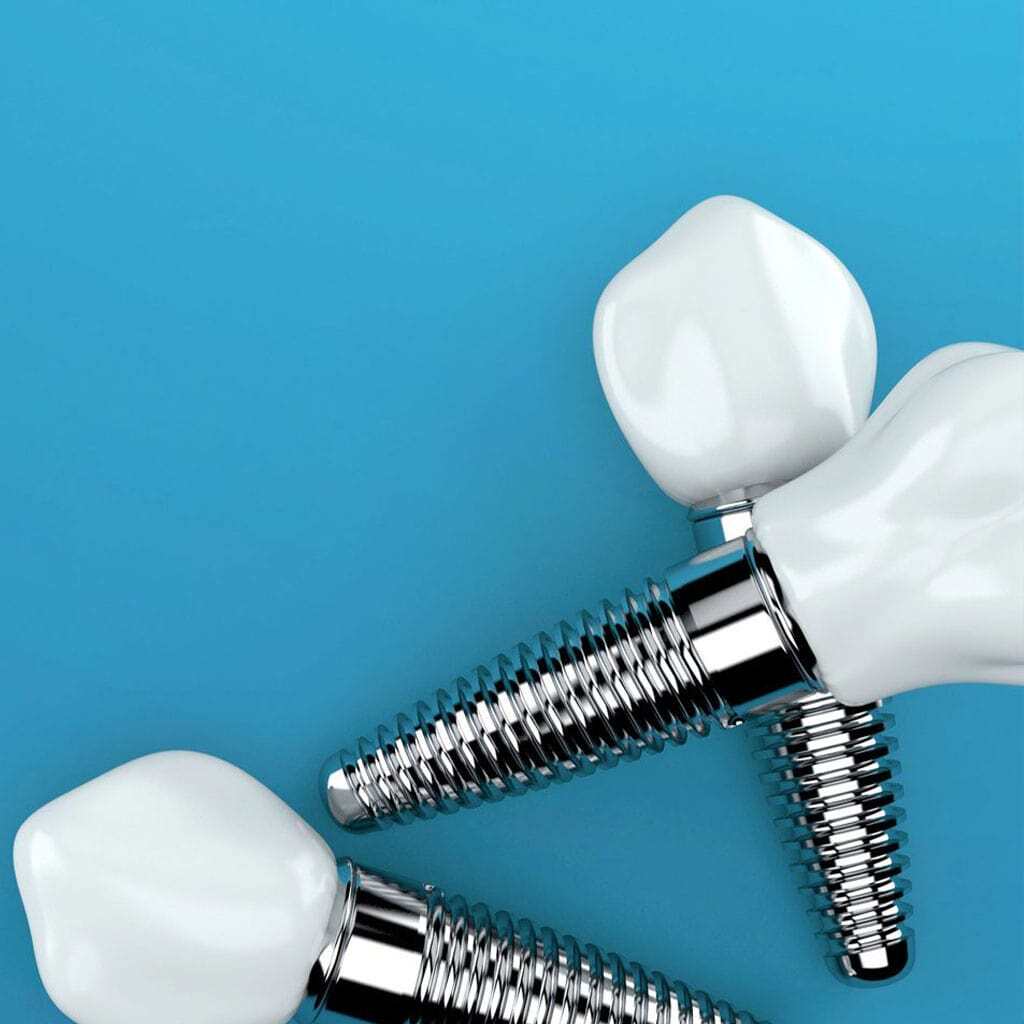 Dental Implants