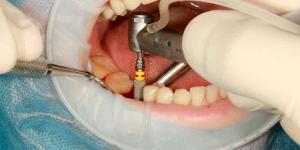 Brooklyn Dental Implants vs. Dental Bridges