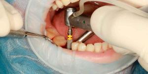 Cheap Dentures Brooklyn 11229 Tips: Understanding Implant-supported Dentures