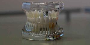 Dentures in a Day Brooklyn: Handling Loose Dentures Part 2 of 2