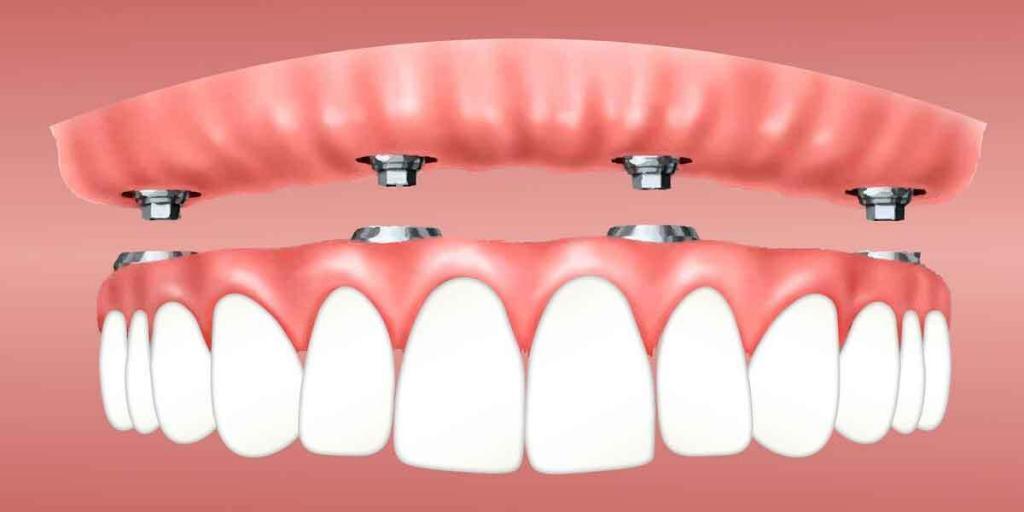 Dentures versus Implants and Why You Need Affordable Dentures Brooklyn 11229 Treatment
