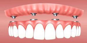 Dentures versus Implants and Why You Need Affordable Dentures Brooklyn 11229 Treatment