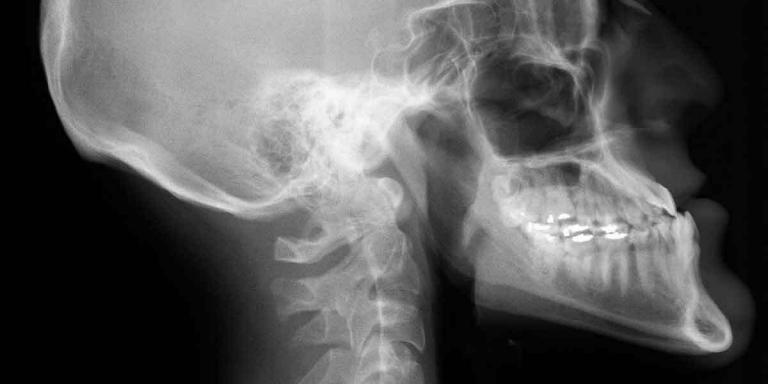 Importance of Getting a Dental X-ray