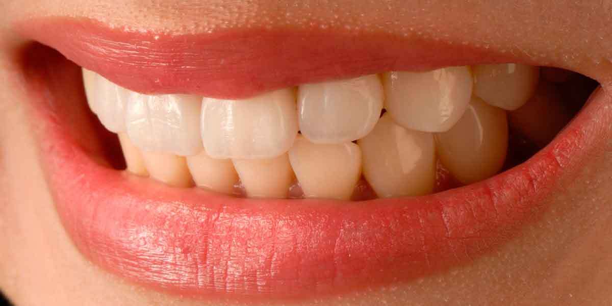 Can My Porcelain Veneer Fail? Eco Dental NY Brooklyn office