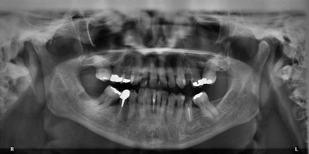 Reasons for Jawbone Deterioration