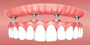 Understanding Mini Dental Implants 2 of 2