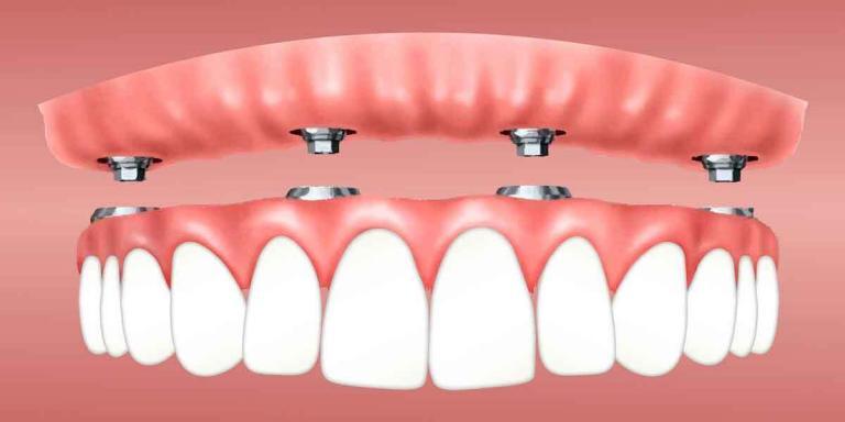 Understanding Mini Dental Implants 2 of 2
