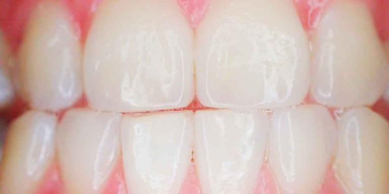 Professional Teeth Whitening Steps