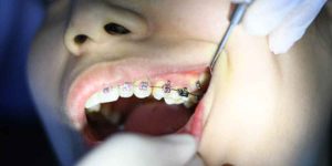 Best Kid Dentist Near Me to Get the Right Braces for Kids
