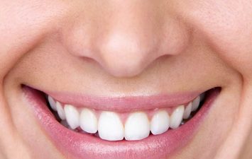 Teeth-Whitening-Dentist-Brooklyn-11229 Teeth Whitening